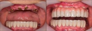 Protesi dentaria fissa Brescia